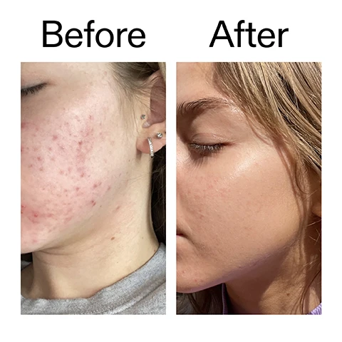 Image 1 - A before and after comparison shows a persons face with widespread acne on the left, labeled Before, and clear, smooth skin on the right, labeled After. Image 2 - A person with wet-looking skin pulls down their lower lip with their hand, sticking their tongue out and winking, above the text Why we love it, Hydrating, Non-sticky texture, Decongests clogged pores and reduces blemishes. Image 3 - A clear liquid forms a large circle with a smaller drop on a white background, accompanied by text that reads Why it works: 2% Salicylic Acid helps to unclog pores and gently exfoliate, and 1% Low-Molecular Weight Hyaluronic Acid to help hydrate and avoid dry skin. Image 4 - A hand holds a white bottle with a black cap, from which a clear liquid drips into the palm, alongside text that reads How to use USE AM + PM. 1-2 DROPS. PAT INTO FACE AND NECK. AFTER CLEANSER, BEFORE MOISTURISER AND SPF IN THE AM. Image 5 - The image shows clear liquid on a white background with text that reads How to layer your routine and a numbered list: 1 CLEANSE, 2 HYDRATE, 3 TREAT, 4 MOISTURISE, 5 SPF.