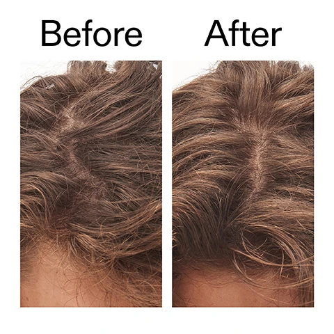Image 1 - A side-by-side comparison of a scalp with brown hair, showing a sparse hair part on the left and a fuller hair part on the right, labeled Before and After. Image 2 - A close-up shot shows a white applicator tip from a black bottle applying a liquid to a persons scalp with dark hair, alongside the text 92% agreed their hair felt healthier after 4 weeks of use* *4-week independent clinical study of 22 people under dermatological and ophthalmological control. Image 3 - A close-up image of a persons dark hair parted at the scalp and their forehead, with text reading Why we love it and bullet points that say Clears buildup and dead skin, Rebalances oil, reduces greasy roots, Instantly smooths with physical + chemical exfoliation. Image 4 - A large irregularly shaped blob of pale yellow liquid with small yellow exfoliating particles, and a small clear droplet below it, against a white background, next to text that reads: Why it works, 7% Glycolic Acid, GENTLY EXFOLIATES TO CLEAR DEAD SKIN AND BUILDUP, 2.5% Symcontrol® Scalp, REGULATES OIL FOR A FRESHER, LESS GREASY SCALP, 2% Castor Beads, BOOSTS INSTANT PHYSICAL EXFOLIATION, 100% BIODEGRADABLE, 0.5% Bioecolia®, SUPPORTS A HEALTHY SCALP MICROBIOME. Image 5 - A hand holds a black bottle of The Inkey List Glycolic Acid Exfoliating Scalp Scrub with a white applicator tip, against a white background featuring instructions How to use: USE 1 - 2 TIMES A WEEK, APPLY TO ENTIRE SCALP ON WET OR DRY HAIR, BEFORE SHAMPOO, LEAVE TO WORK FOR 10 MINUTES THEN RINSE WELL, and text on the bottle reads THE INKEY LIST, 5.0 US fl.oz / 150ml e, GLYCOLIC ACID EXFOLIATING SCALP SCRUB, Removes product buildup and leaves hair looking healthy, Élimine laccumulation de produit et laisse les cheveux visiblement sains, Best for: everyone, Idéal pour: tous types.
