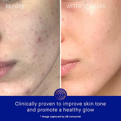 Image 3 - A split image shows the left side labeled BEFORE, depicting a person with visible acne and uneven skin tone, and the right side labeled AFTER 12 WEEKS, showing clearer skin with a healthy glow; at the bottom, the text reads Clinically proven to improve skin tone and promote a healthy glow * Image captured by AB consumer.
Image 4 - A blue serum bottle with a gold cap is shown alongside text stating Clinically Proven Results, Skin looks 52% younger, Skin hydration is improved by 3.3x after 1 hour, and The appearance of fine lines and wrinkles are reduced by 32%.
Image 5 - A skincare product set against a light background, featuring a blue bottle with a gold cap labeled Augustinus Bader, accompanied by a clear glass orb and text highlighting user proven results: 83% agree skin feels instantly and deeply hydrated, 92% agree dull skin appears more luminous, and 79% agree skin discoloration is diminished and skin looks more even, with a note indicating the data is based on a 4-week Consumer Perception Study of 52 participants.
Image 6 - Image of a blue skincare bottle with a gold cap, labeled THE CREAM by Augustinus Bader, accompanied by claims about TFC8, Vitamin A, Vitamin B5, and Vitamin C that highlight their benefits for skin renewal, moisture retention, and improved complexion.
Image 7 - Image shows two product descriptions for moisturizers by Augustinus Bader: on the left, The Cream with a lightweight daily moisturizer that hydrates and revitalizes, ideal for combination to oily skin, and on the right, The Rich Cream as a luxuriously rich daily moisturizer that nourishes and renews, ideal for normal to dry skin; visible text includes texture, key benefits, key concerns, and ideal for categories for both products.
Image 8 - An image showcasing a skincare routine with four steps, each featuring a product: 1. Cleanse with a cream cleansing gel, 2. Correct & Hydrate with a serum, 3. Nourish & Renew with either the cream, rich cream, or ultimate soothing cream, and 4. Perfect & Revitalize with an eye cream.
Image 9 - Four Augustinus Bader skincare products displayed in a row: a small blue bottle (15 ml), medium bottle (30 ml), larger bottle (50 ml), and the largest bottle (100 ml), all featuring gold tops and the brand logo, with visible text indicating the product sizes and names.