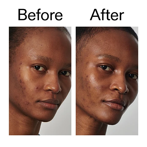 Image 1 - A split image displays a person with dark skin before and after skin treatment, with the left side showing blemishes and the right side showing clearer, smoother skin, labeled Before and After. Image 2 - A close-up of a persons face with numerous freckles around their eyes and nose, with the text Clinically proven to control oil for 8 hours* *Independent clinical study of 20 people. Image 3 - A close-up of a person with freckles smiling, with text that reads: Clinically proven to control oil for 8 hours* 92% agree pores look and feel smoother after 3 days** 92% agree skin feels fresh, balanced and less shiny after 3 days** *Independent clinical study of 20 people **4 week independent consumer trial of 50 people with oily skin. Image 4 - A close-up image shows a persons eyes with visible wrinkles, accompanied by the text Why we love it, followed by a bulleted list: Lightweight and fast-absorbing; Balances skin without drying or stripping; Reduces breakouts & post-blemish marks. Image 5 - A white background features a swirl of white cream on the right, with text on the left detailing Why it works: 20% Niacinamide BALANCES EXCESS OIL, AND IMPROVES THE SKIN TEXTURE AND MINIMISES PORES. 0.5% Zinc PCA TARGETS BUMPS AND TEXTURE CAUSED BY SEBUM BUILD-UP. 3% Squalane PROTECTS THE SKIN BARRIER. Image 6 - A persons fingers hold a pea-sized amount of clear gel product, next to text outlining product usage instructions: How to use USE AM/PM. PEA-SIZED AMOUNT. MASSAGE INTO FACE AND NECK. AFTER CLEANSER, BEFORE MOISTURISER AND SPF IN THE AM. Image 7 - The image displays a creamy white background with text explaining a skincare routine. The text reads: How to layer your routine, followed by a numbered list: 1 CLEANSE, 2 HYDRATE, 3 TREAT, 4 MOISTURISE, 5 SPF.
