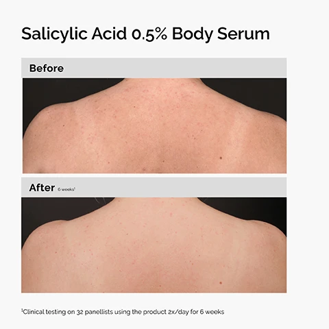 Image 2 - A person holds a white bottle of The Ordinary Salicylic Acid 0.5% Body Serum against their shoulder and arm, with visible text reading Salicylic Acid 0.5% Body Serum, Clears blemish-prone body skin, Exfoliates skin to help unblock pores, Reduces appearance of redness, The Ordinary. Body Care., Clinical Formulations with Integrity. Formulations Cliniques Empreintes dIntégrité., Salicylic Acid 0.5% Body Serum An Exfoliating Solution Formulated for Blemish-Prone Skin, and Sérum Corps à lAcide Salicylique 0.5% Une Solution Exfoliante Formulée pour les Peaux Sujettes aux Imperfections. Image 3 - Image demonstrating the effects of Salicylic Acid 0.5% Body Serum, showing a Before image of a back with acne and an After 6 weeks¹ image of the same back with reduced acne, with the footnote ¹Clinical testing on 32 panellists using the product 2x/day for 6 weeks. Image 4 - A person with dark skin holds a white pump bottle of skincare product, with prominent text Niacinamide 5% Face and Body Emulsion, alongside benefit statements Targets the look of uneven skin tone, Smooths skin texture across face and body, and Hydrates and supports skin barrier, and additional text on the bottle reading Clinical Formulations with Integrity, Formulations Cliniques Empreintes DIntégrité, The Ordinary, Body Care, Niacinamide 5% Face and Body Emulsion, A Multi-Functional Formula for Brighter Skin, Émulsion Visage et Corps à la Niacinamide 5%, Une Formule Multifonctionnelle pour un Teint Plus Lumineux. Image 5 - The image presents a Before and After comparison of skin on the upper chest and shoulders, illustrating the results of Niacinamide 5% Face and Body Emulsion; the Before image shows skin with visible dark spots and uneven tone, and the After 12 weeks image shows reduced dark spots and improved skin evenness, with a footnote explaining Clinical testing on 49 panellists using the product 2x/day for 12 weeks. Image 6 - The image shows a persons hand with varied skin tones holding a white pump bottle, with the prominent text Natural Moisturizing Factors + Inulin Body Lotion, followed by benefits: Provides all-day continuous moisture, Keeps skin hydrated, even after washing, Strengthens the skins barrier in one application; and text from the bottle: Clinical Formulations with Integrity. Formulations Cliniques Empreintes dIntégrité., The Ordinary. Body Care., Body Surface Hydration Formula, Lotion Corps - Facteurs Naturels dHydratation + Inuline, Formule dHydratation de Surface pour le Corps. Image 7 - The image displays a before and after comparison of skin texture, with the top section showing very dry, visibly cracked skin labeled Before, and the bottom section showing significantly smoother, less cracked skin labeled After 2 weeks¹, for the product Natural Moisturizing Factors + Inulin Body Lotion, with a footnote stating ¹Clinical testing on 33 panelists using the product 2x/day for 2 weeks.